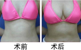 整形丰胸手术,揭秘现代美容技术的魅力与安全